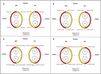 Optimal Lesion Size Index for Pulmonary Vein Isolation in High-Power Radiofrequency Catheter Ablation of Atrial Fibrillation